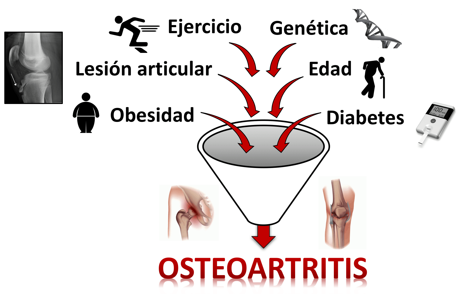 osteoartirtitis